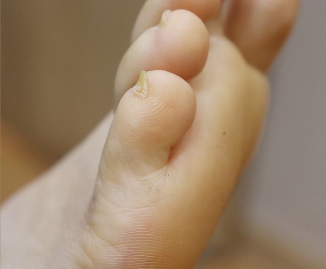 사마귀 치료 후