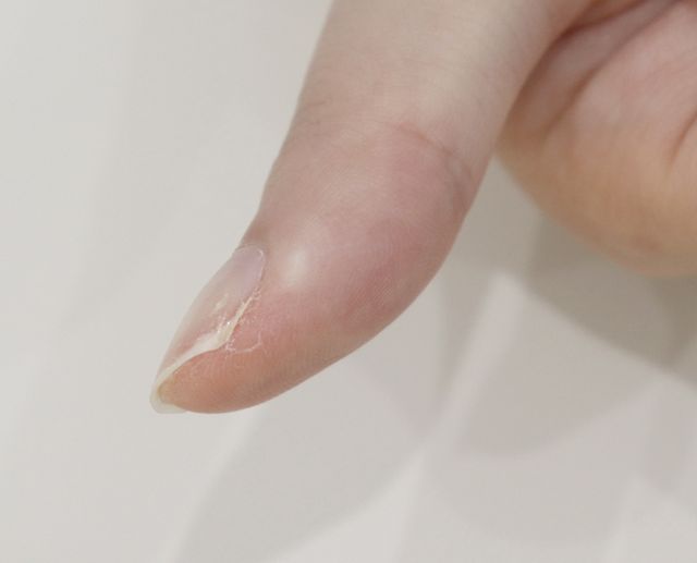 사마귀 치료 후