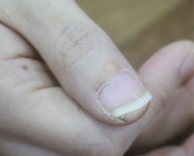 사마귀 치료 전