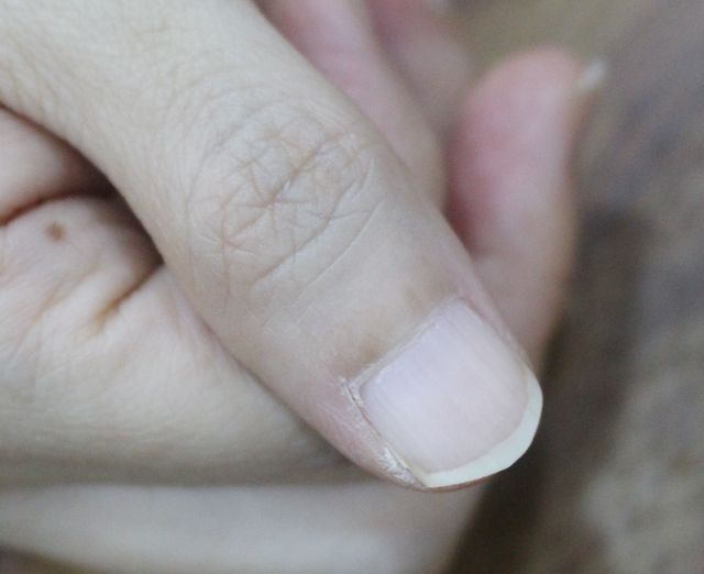 사마귀 치료 후