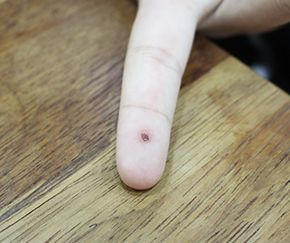 사마귀 치료 전