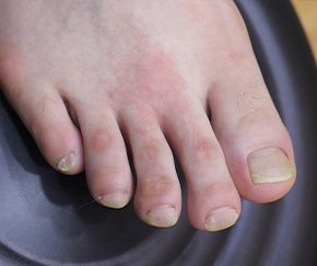 사마귀 치료 후