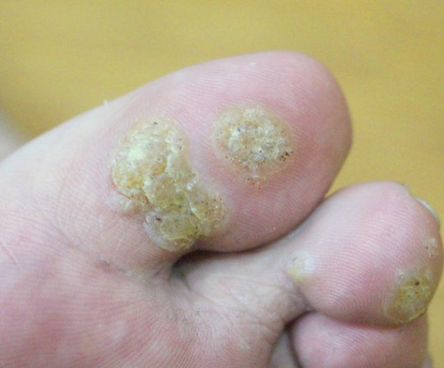 사마귀 치료 전