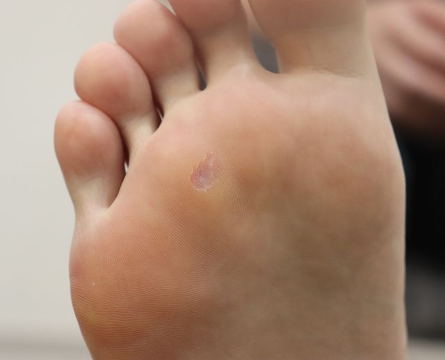 사마귀 치료 후