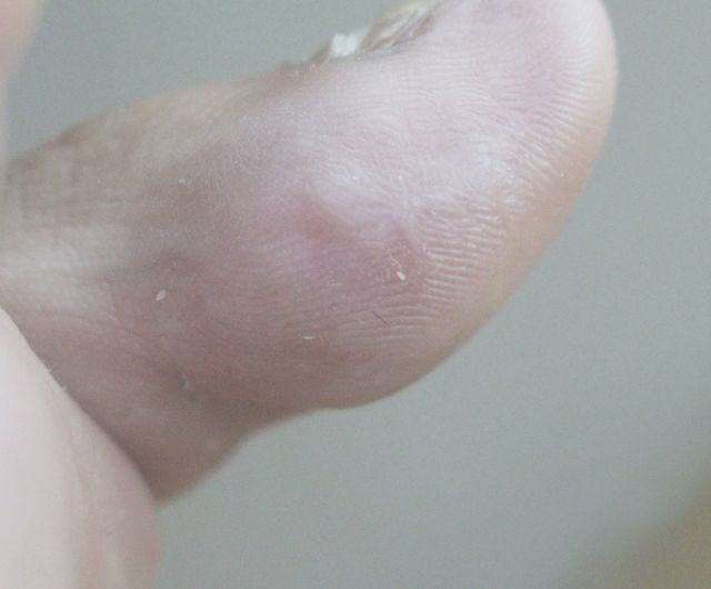 사마귀 치료 후