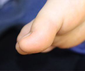 사마귀 치료 후