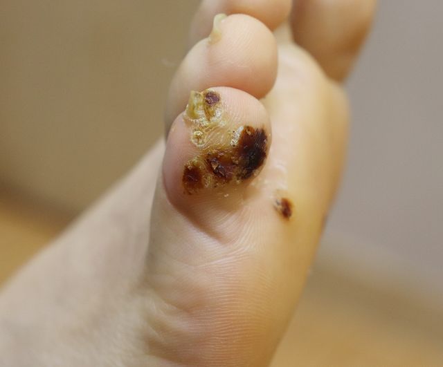 사마귀 치료 전