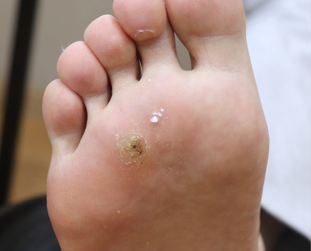사마귀 치료 전